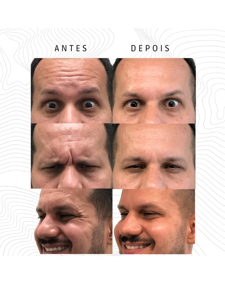 Toxina Botulínica 1