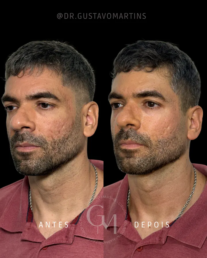 Harmonização Facial — paciente 1