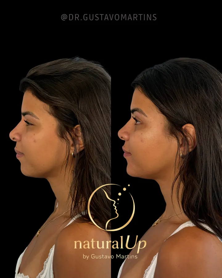 Caso 1 — Método NaturalUp®