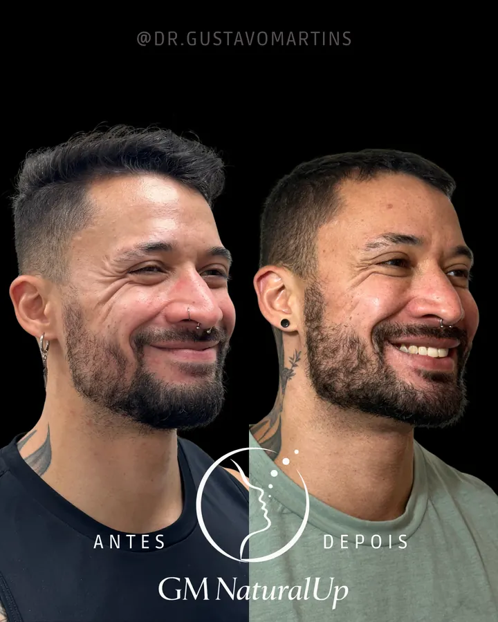 Harmonização Facial — paciente 5