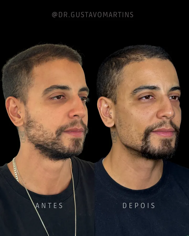 Resultado Harmonização 8
