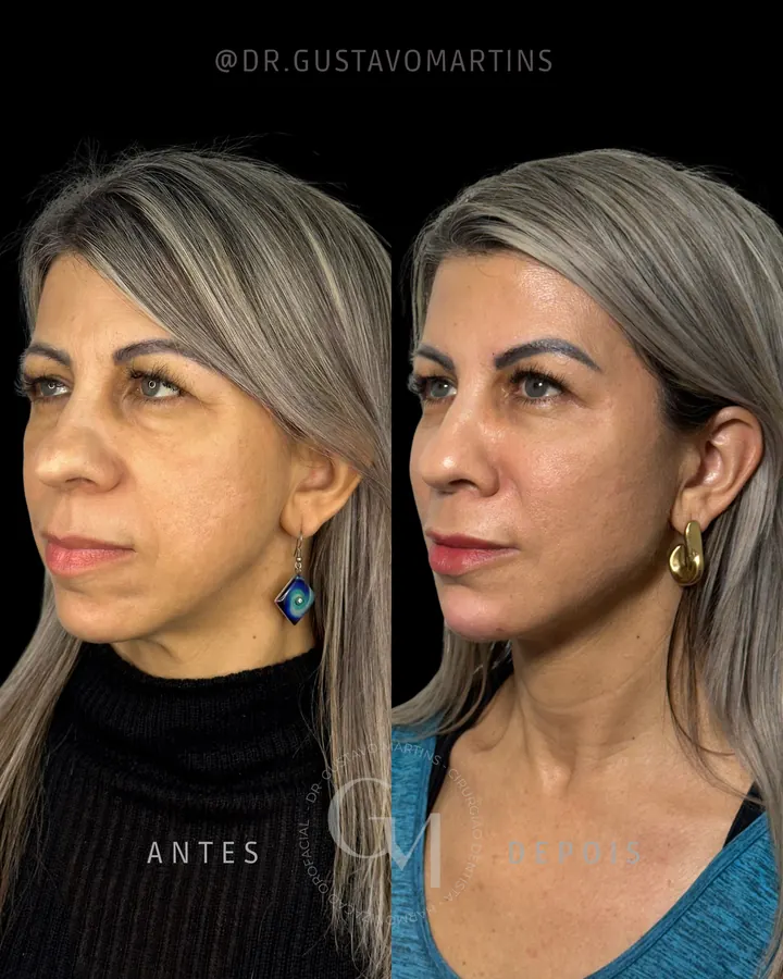 Harmonização Facial — paciente 10