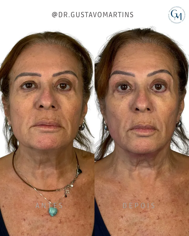 Harmonização Facial — paciente 15