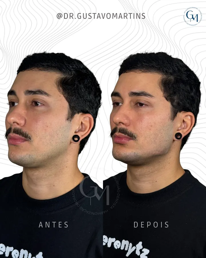 Resultado Harmonização 18
