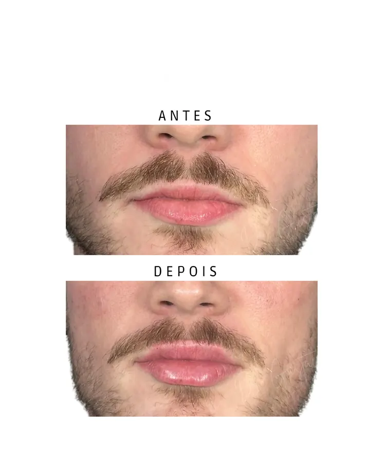 Preenchimento Labial 3