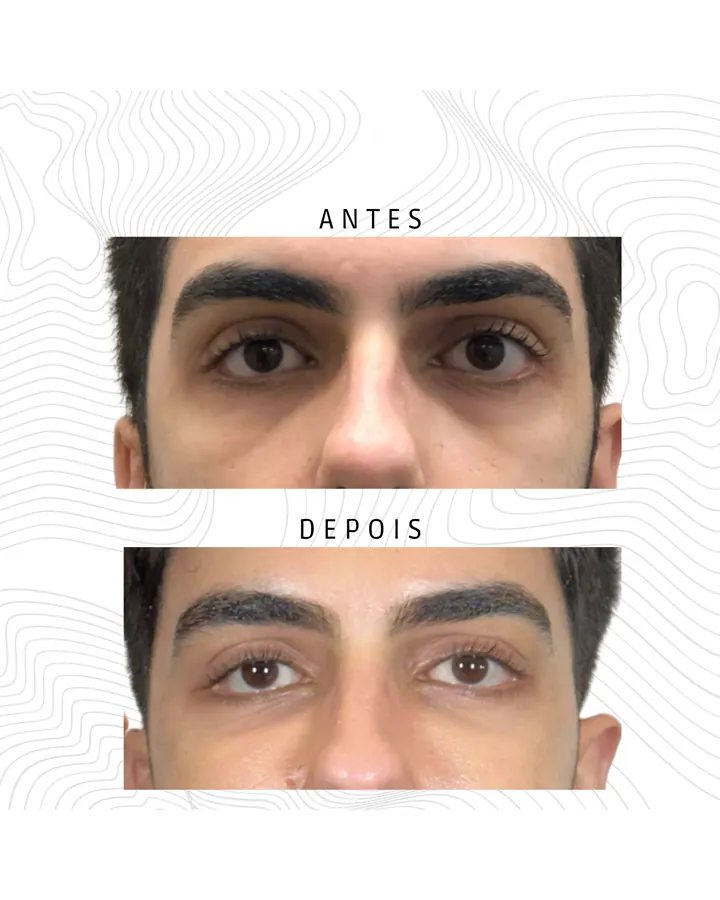 Tratamento de Olheiras 1