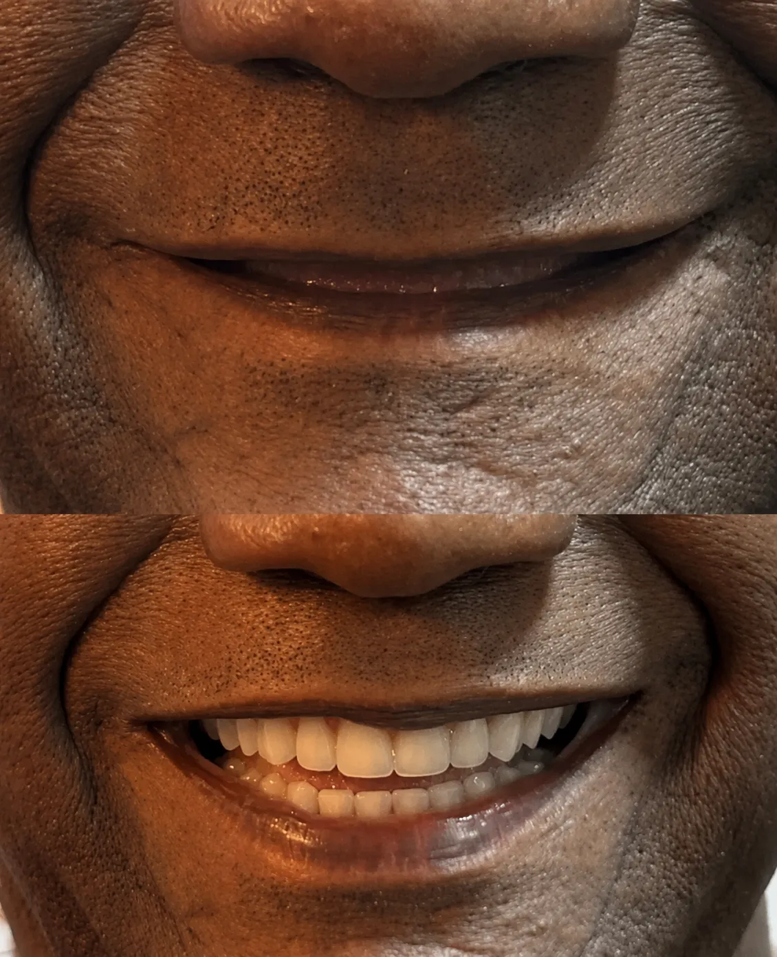 Implante dentário antes e depois na Isiortho