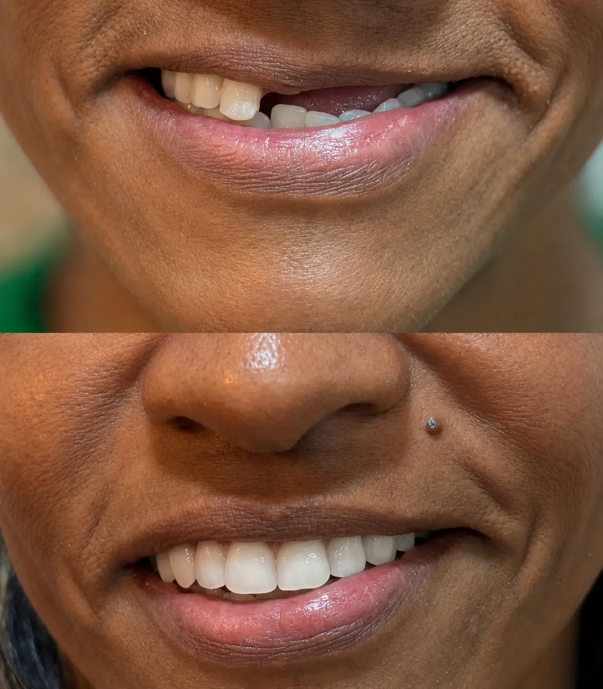 Reabilitação protocolo antes e depois na Isiortho
