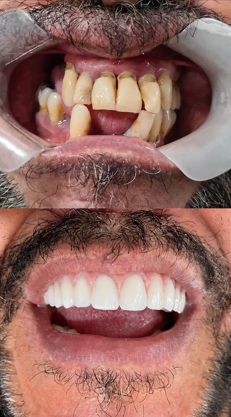Prótese protocolo fixa antes e depois na Isiortho