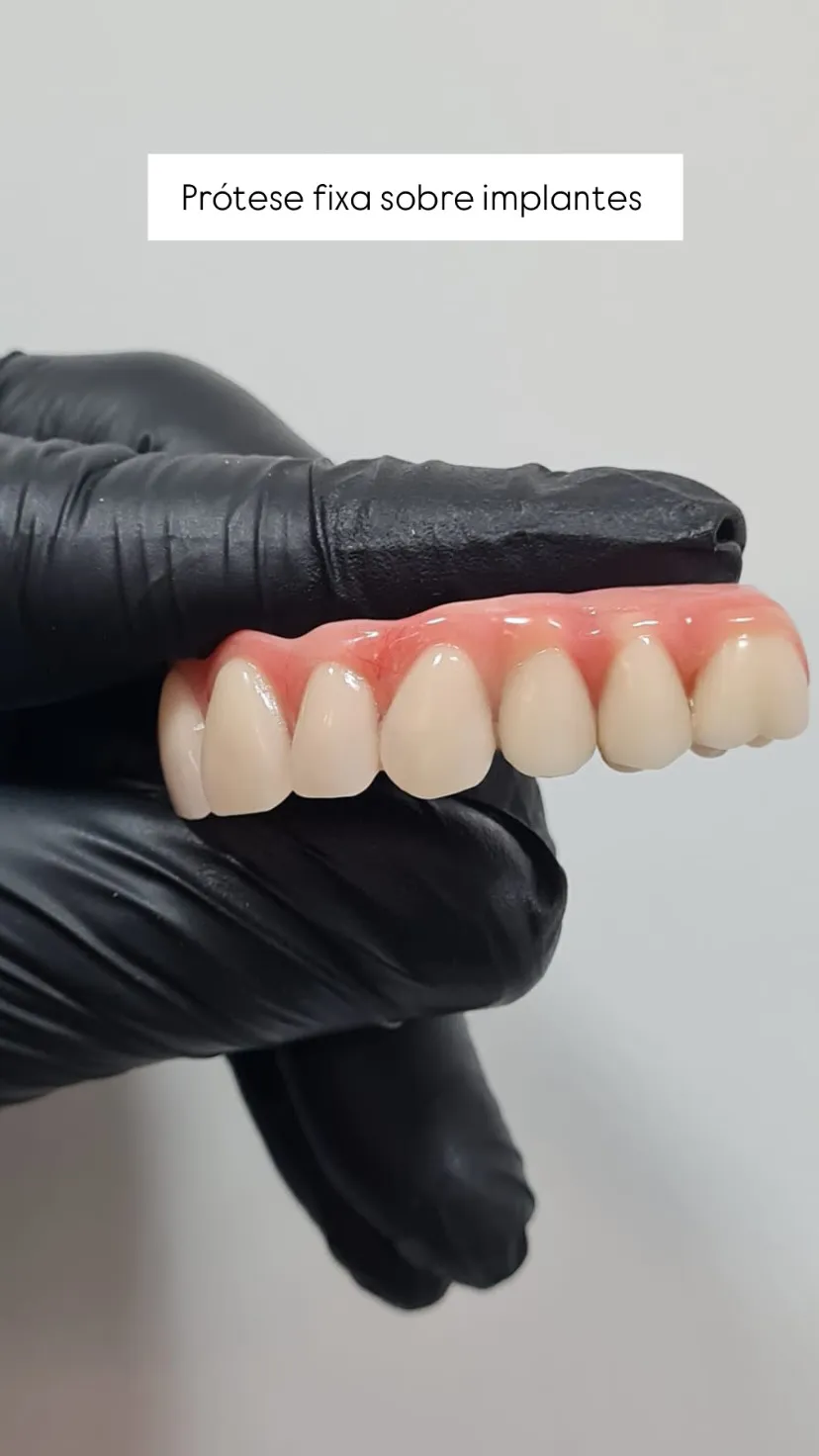 Prótese fixa sobre implantes feita na Isiortho