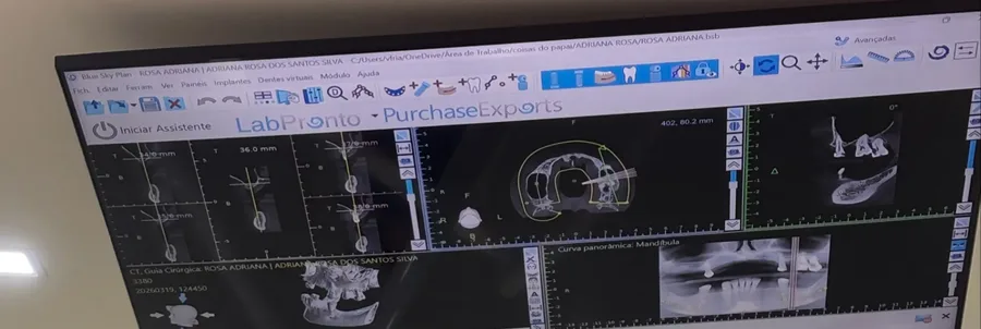 Planejamento digital de Implante Dentário na Isiortho