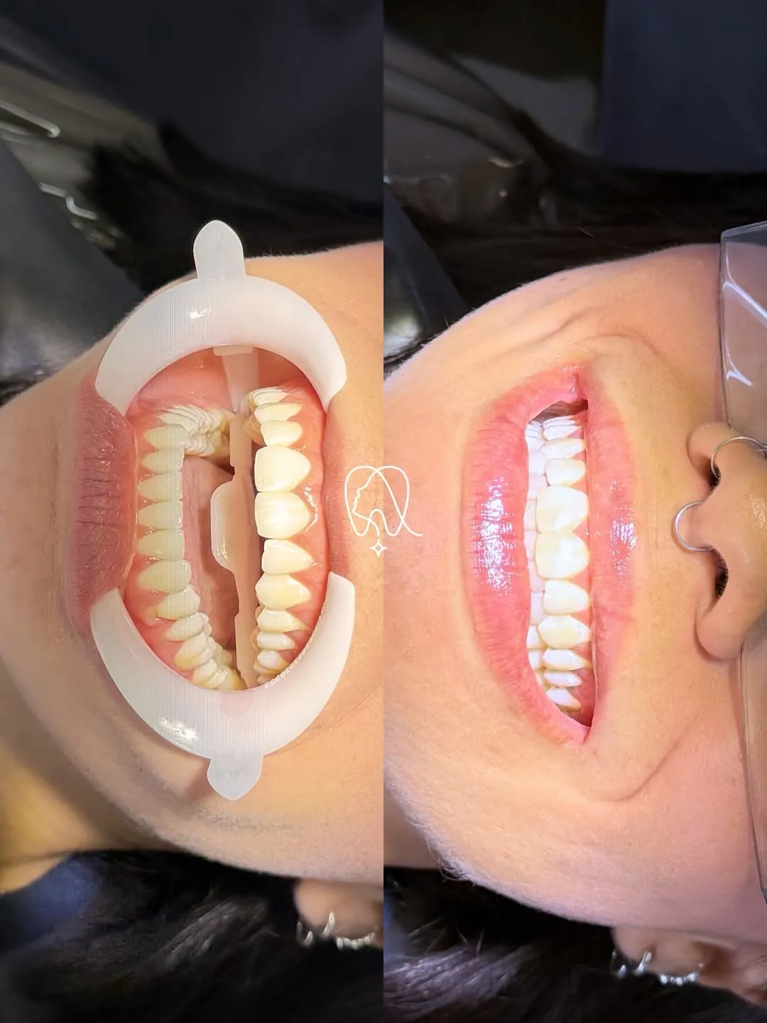 Clareamento dental antes e depois