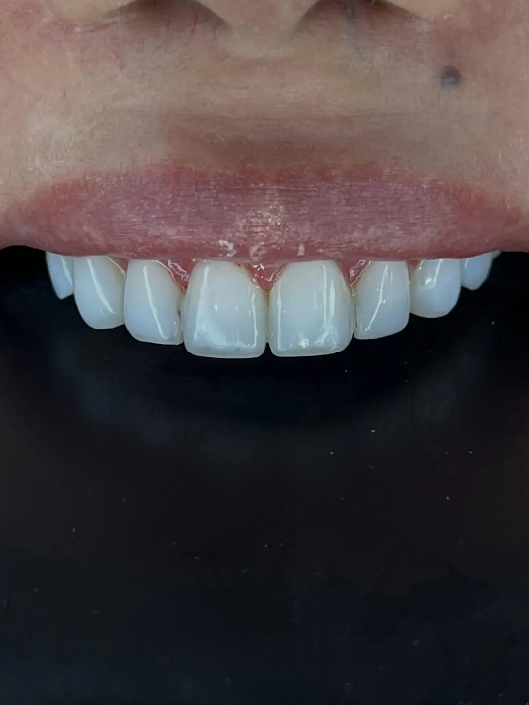 Estética Dental - Facetas