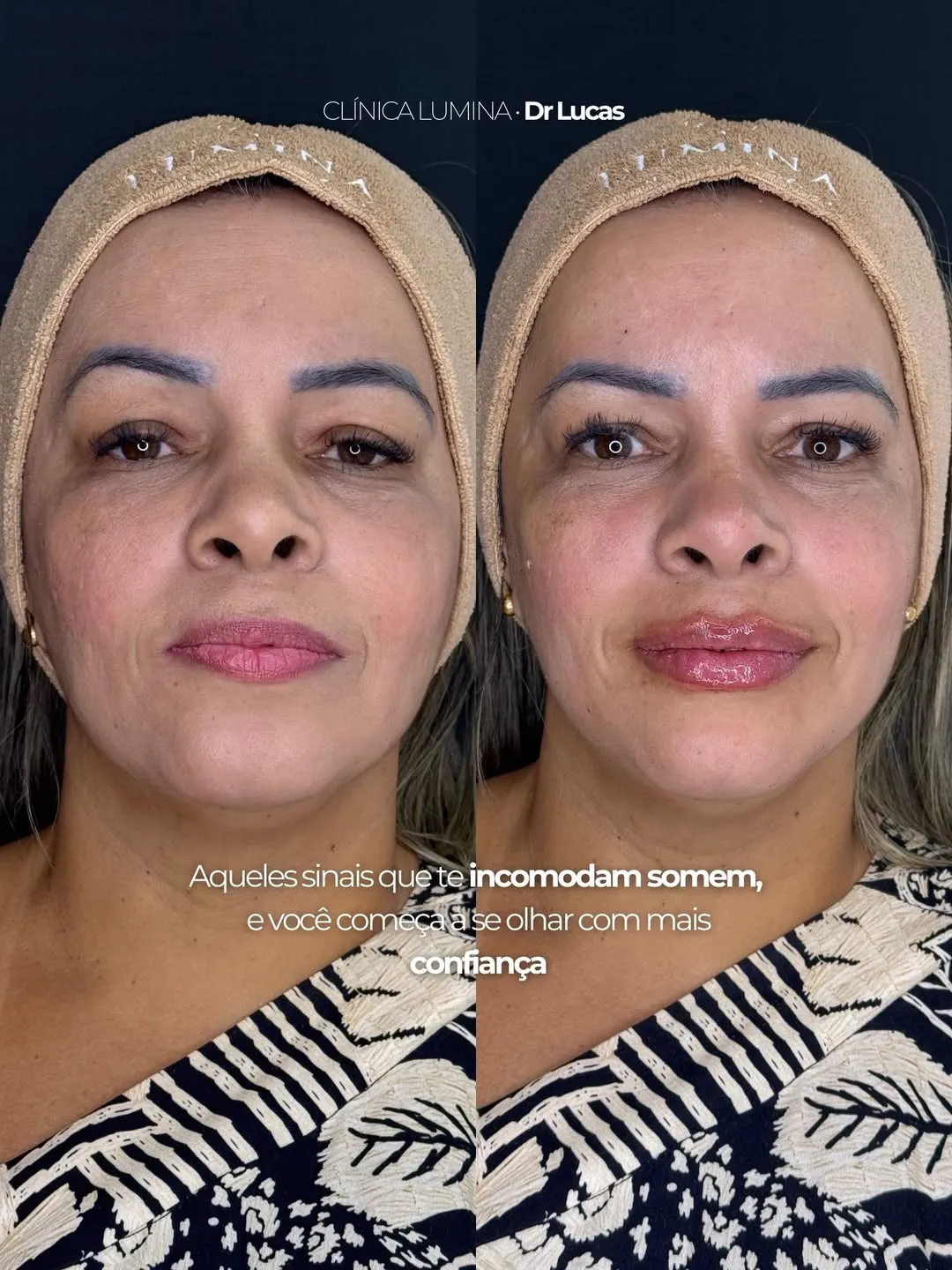 Harmonização facial antes e depois