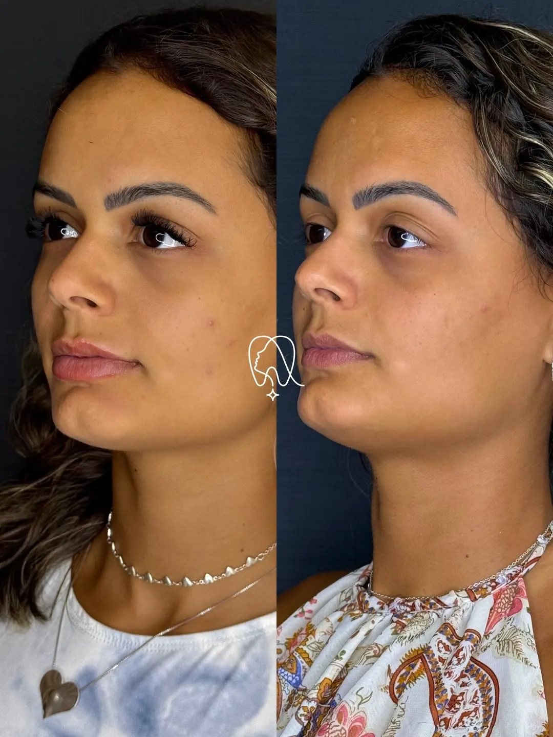 Harmonização Orofacial
