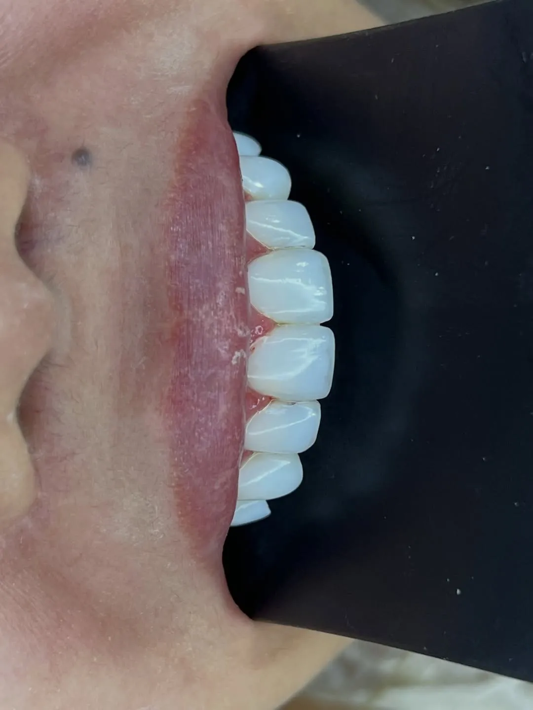 Lentes de contato dental