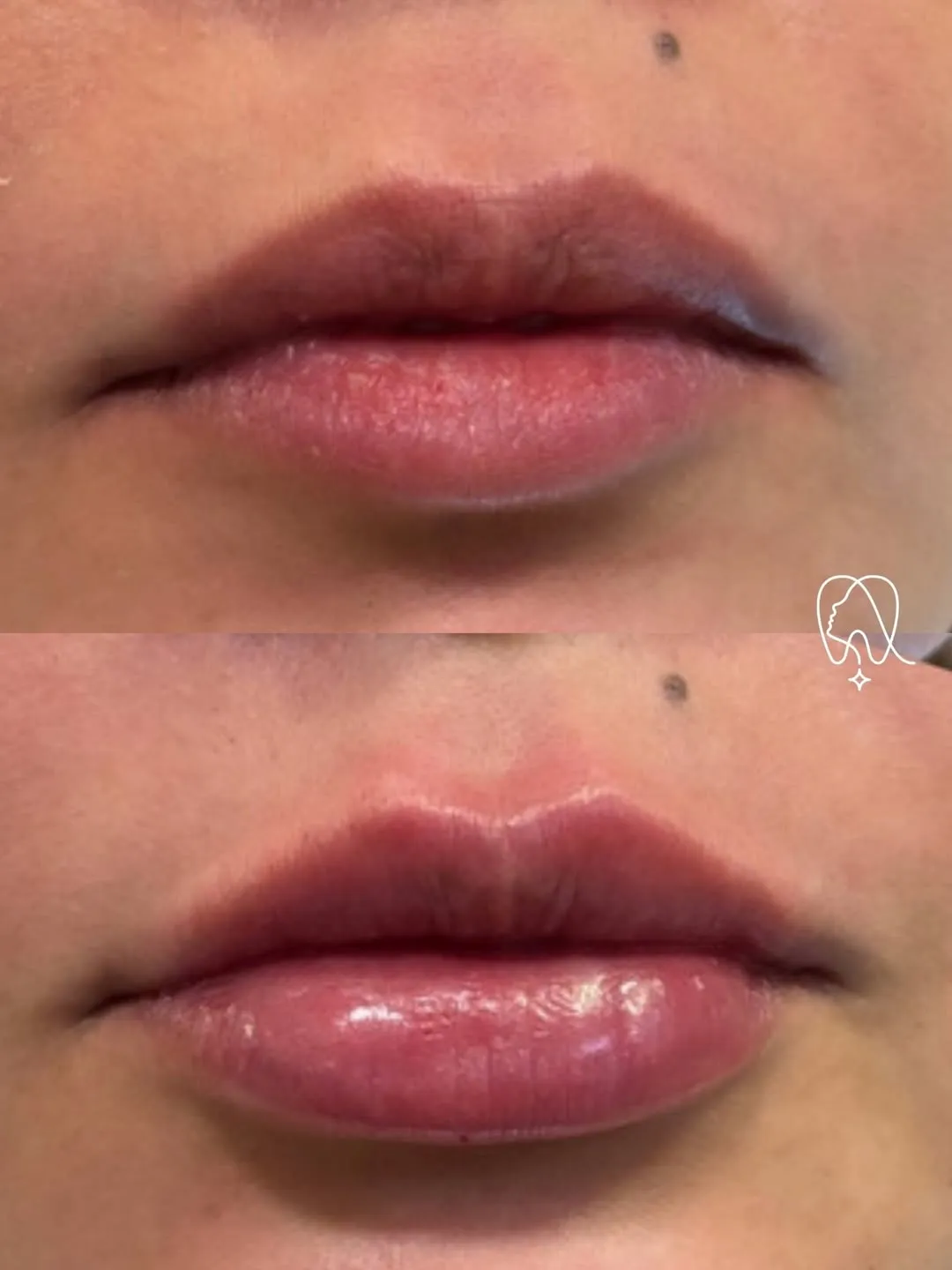 Preenchimento labial antes e depois