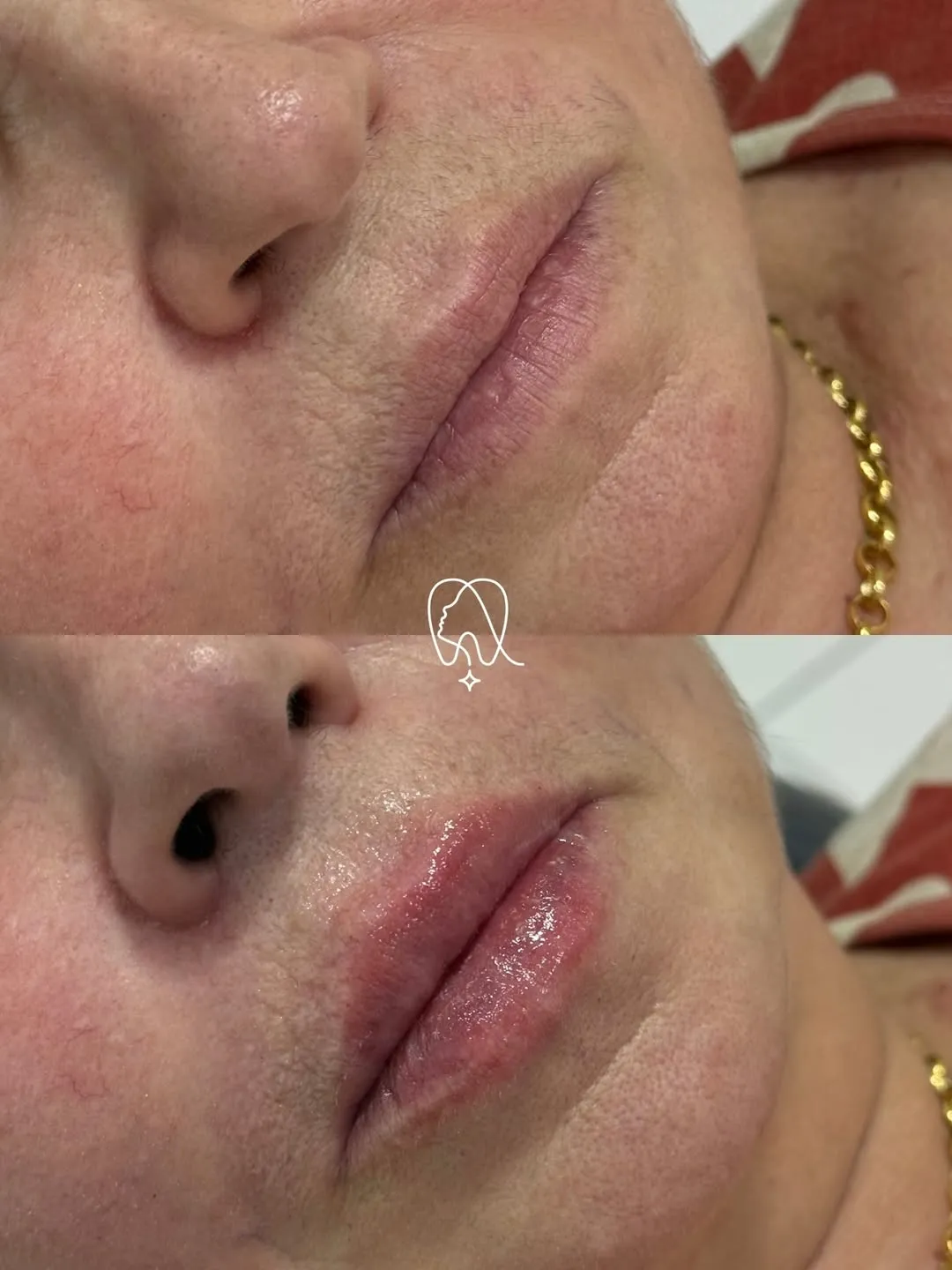 Rejuvenescimento labial